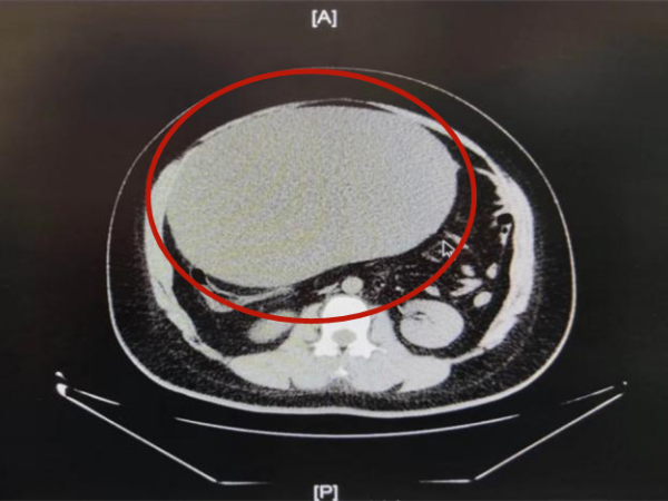 道正网 罕见！郑州21岁少女腹中惊现16斤重的囊物！堪比怀了三胞胎...